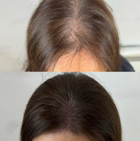 Sérum roll-on pour la croissance des cheveux