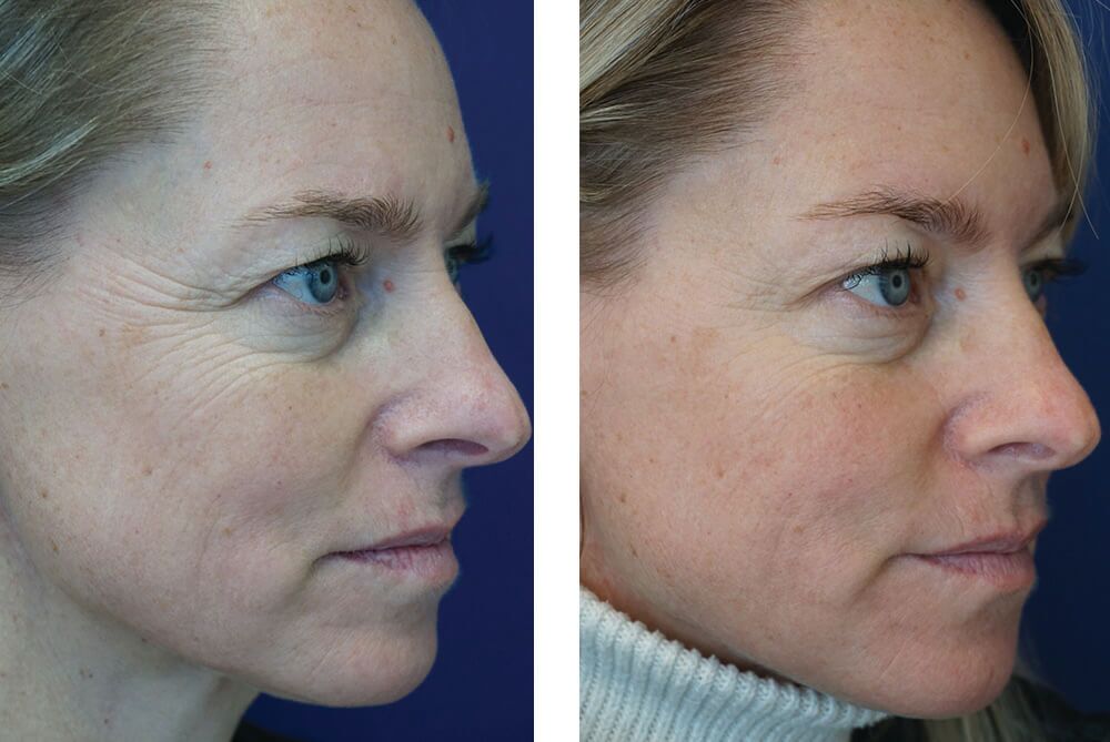 Zooone - Supplément NAD nicotinamide riboside